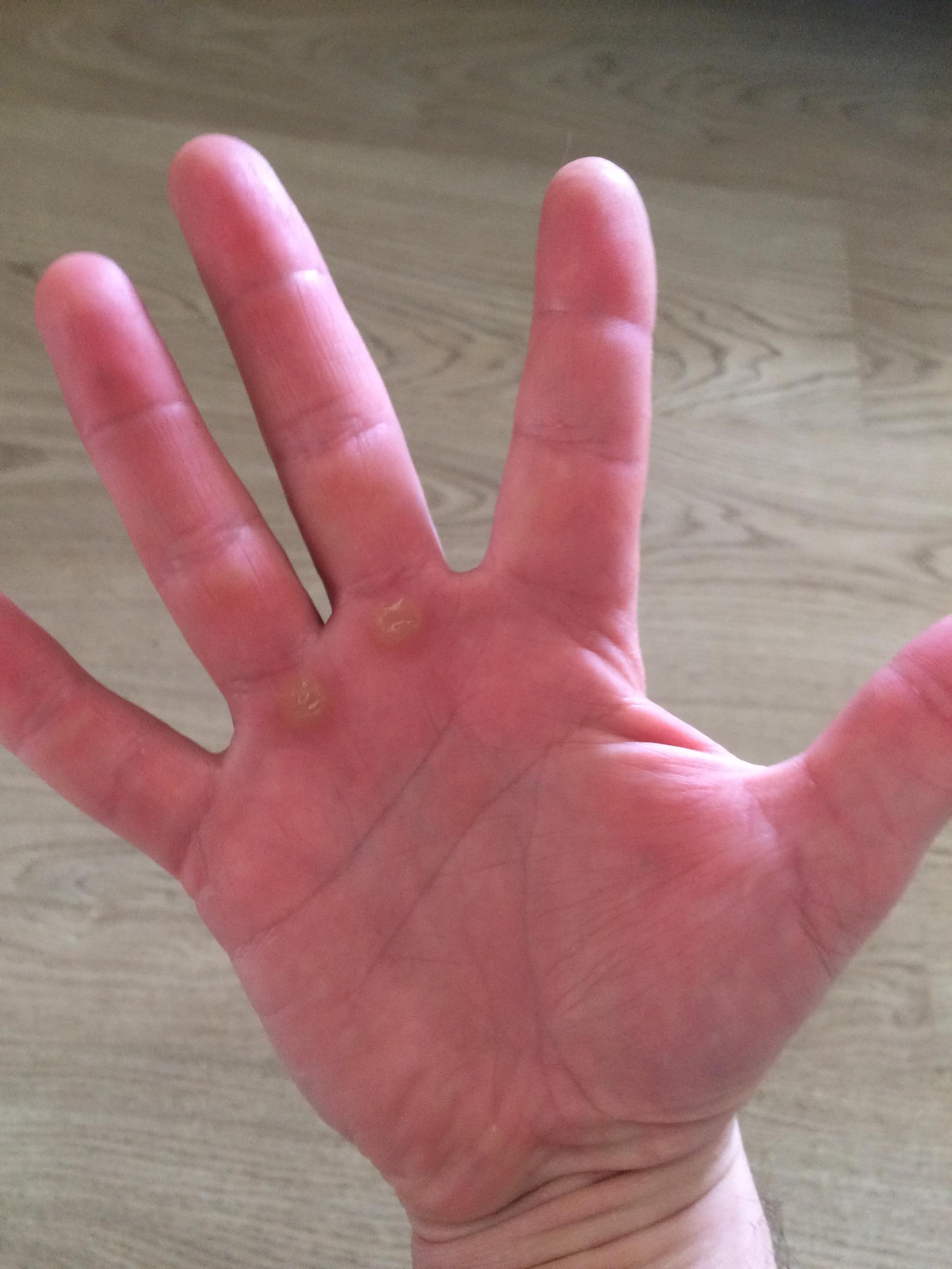 100-дневный воркаут 2017 (Весна) - День 23.  Мозоли от тренировок