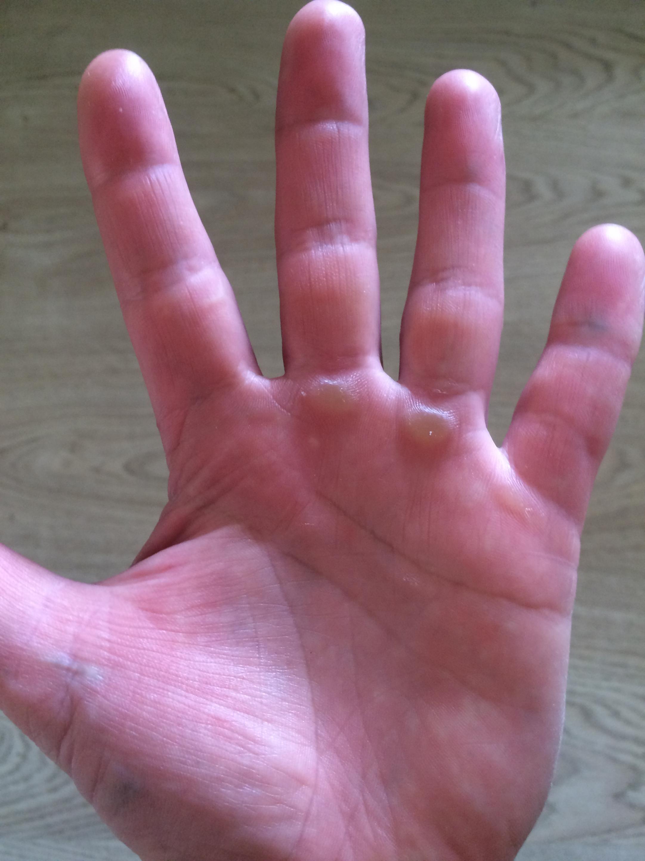 100-дневный воркаут 2017 (Весна) - День 23.  Мозоли от тренировок